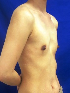 ③術前　右斜位